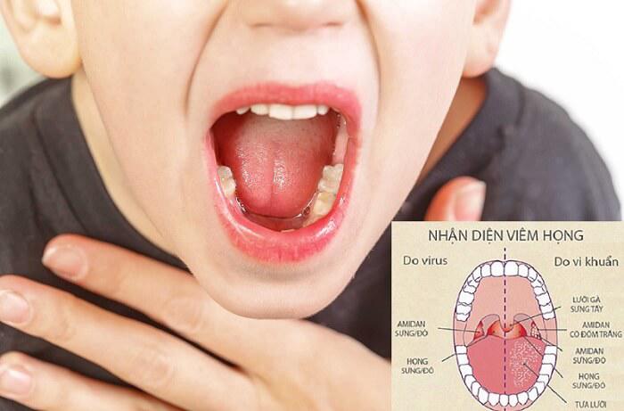 Viêm họng ở trẻ và cách trị liệu
