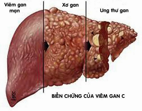 Viêm gan C